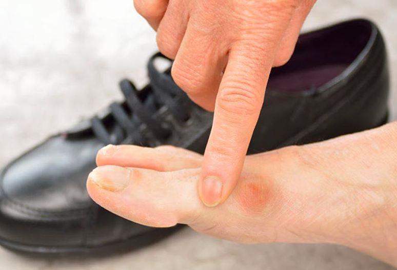 Mang giày bị đau ngón chân có thể do đi giày quá chật